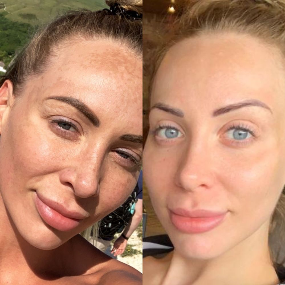rachael katie skin before & after 2
